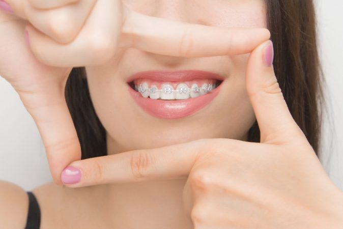 Dental braces in happy womans mouths through the frame. Brackets on the teeth after whitening. Self-ligating brackets with metal ties and gray elastics or rubber bands for perfect smile. Orthodontic teeth treatment