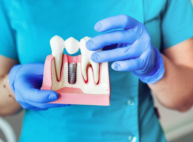 Close up of a Dental implant model. hands of the dentist holding