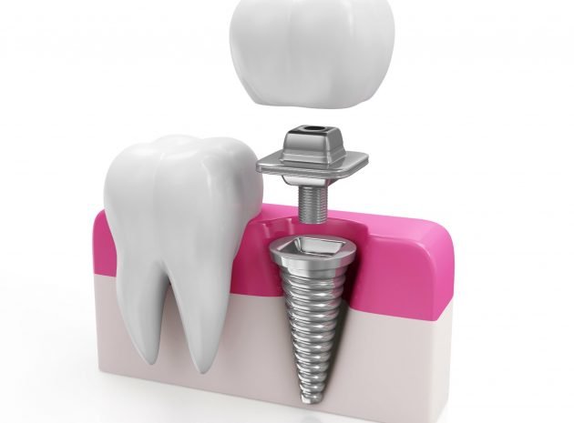 health-tooth-and-dental-implant