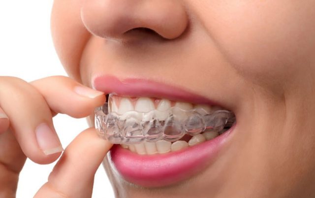 invisalign