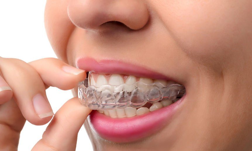 invisalign