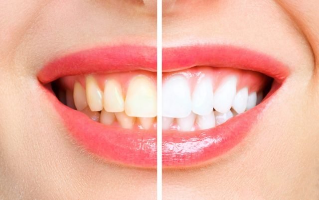 woman teeth before and after whitening. Over white background. Dental clinic patient. Image symbolizes oral care dentistry, stomatology.